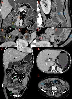 Case report: Rapidly progressive neurocognitive disorder with a fatal outcome in a patient with PU.1 mutated agammaglobulinemia